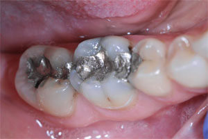 Patient tooth fillings