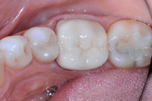 tooth alignment before