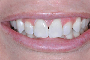 patient tooth gap after