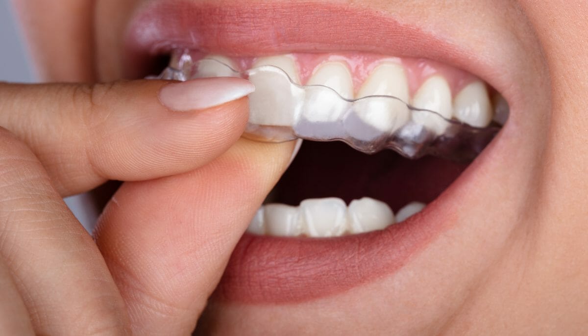 Close-up of woman placing clear braces on her white teeth