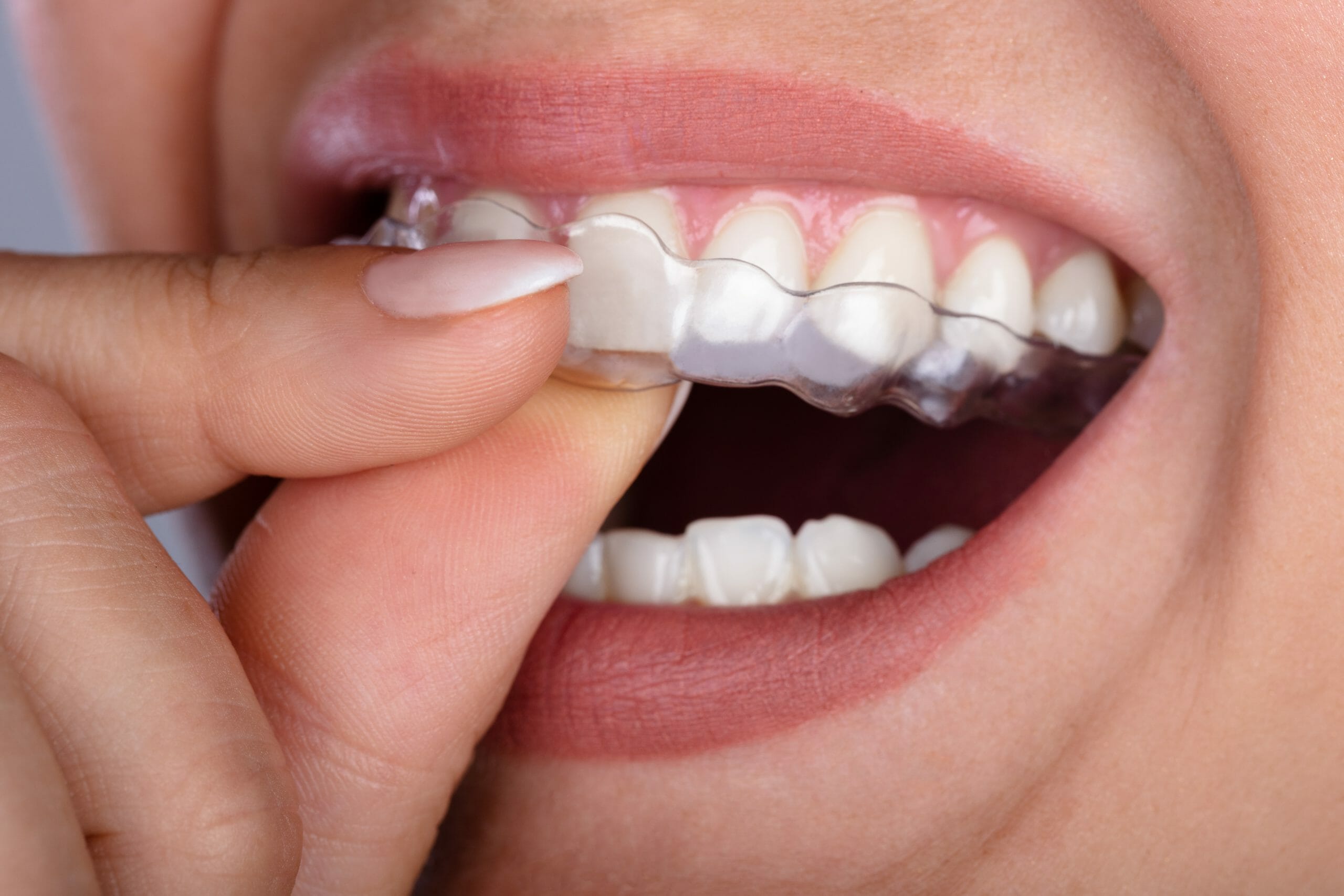 Close-up of woman placing clear braces on her white teeth